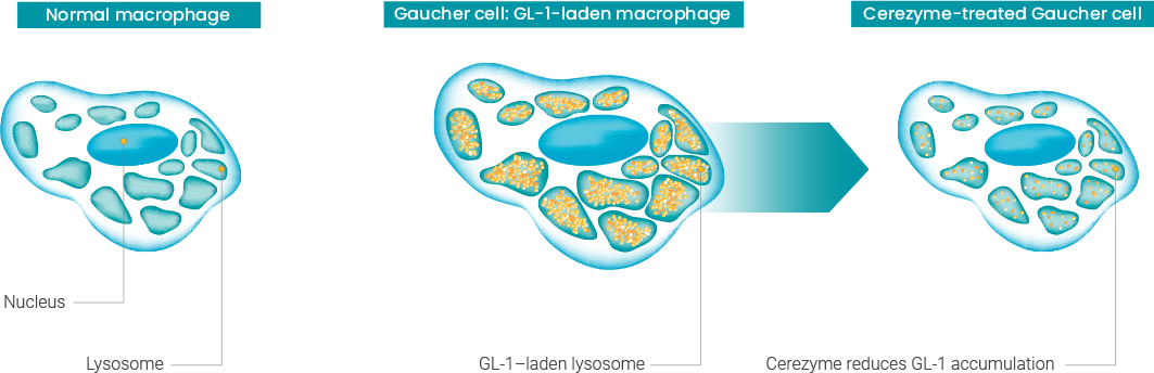 Normal macrophage, Gaucher cell: GL-1-laden macrophage, Cerezyme-treated Gaucher cell