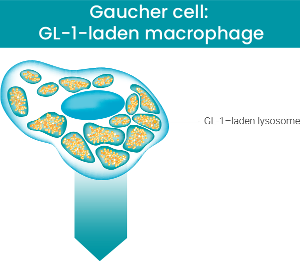 Gaucher cell: GL-1-laden macrophage